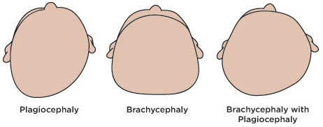 Plagiocephaly, Positional Plagiocephaly, Flat Head Syndrome